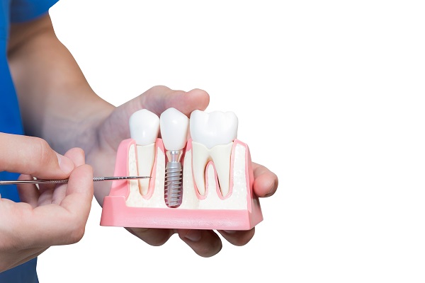 A Procedure Guide To Getting A Dental Implant