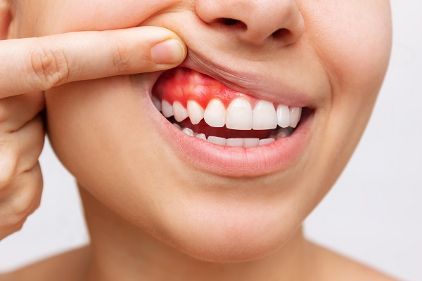 What Happens If Gum Disease Goes Untreated?