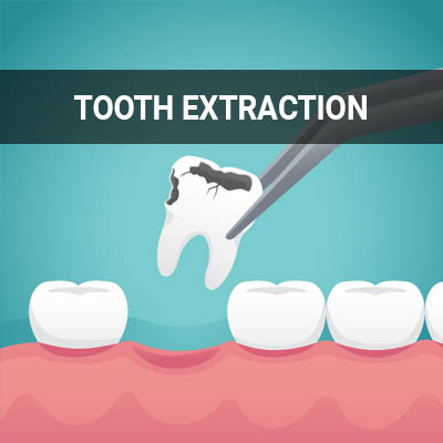 Navigation image for our Tooth Extraction page